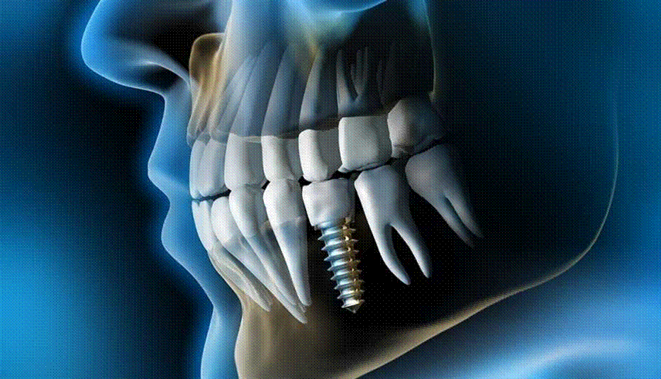 ایمپلنت‌ دندان