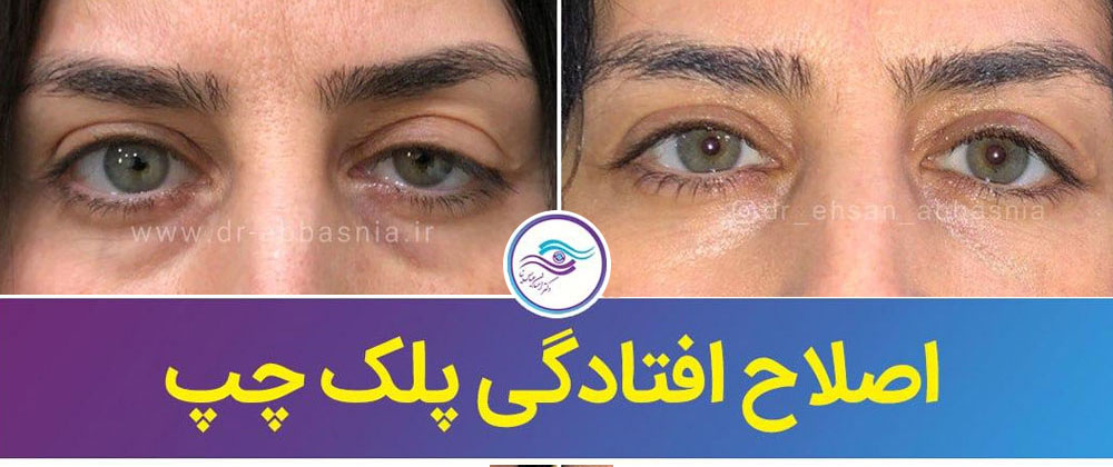 درمان افتادگی پلک بدون جراحی